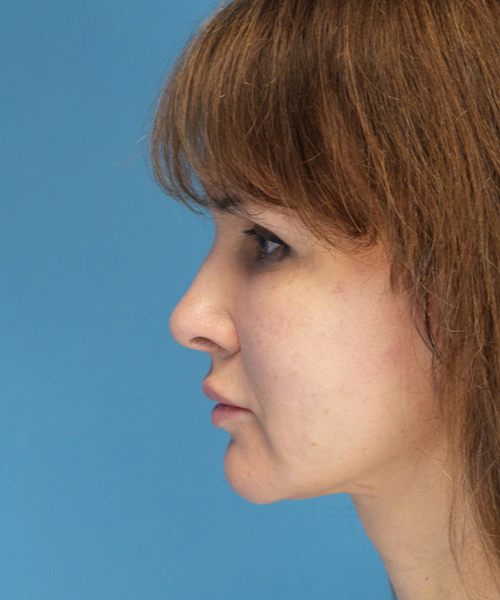 after mini facelift left side view case 4847 | Crispin Plastic Surgery Atlanta, GA
