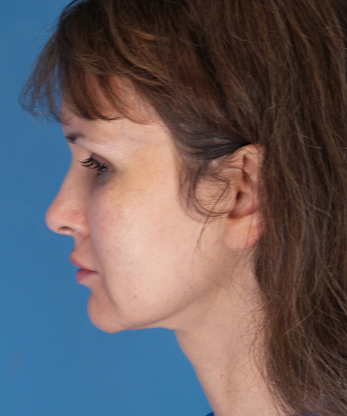 before mini facelift left side view case 4847 | Crispin Plastic Surgery Atlanta, GA