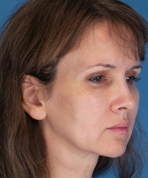 before mini facelift front right diagonal view case 4847 | Crispin Plastic Surgery Atlanta, GA
