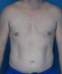 after gynecomastia front view male patient case 1446