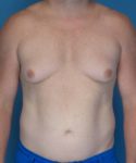 before gynecomastia front view male patient case 1446