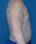 after gynecomastia right side view male patient case 1446
