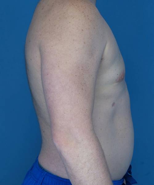 after gynecomastia right side view male patient case 1446