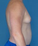 before gynecomastia right side view male patient case 1446