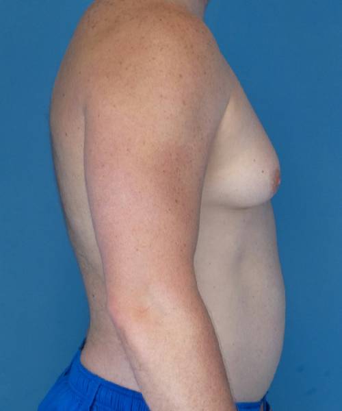 before gynecomastia right side view male patient case 1446