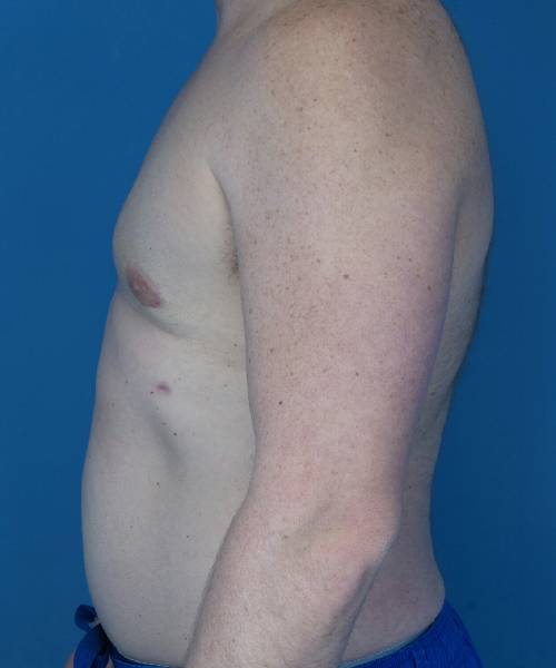 after gynecomastia left side view male patient case 1446