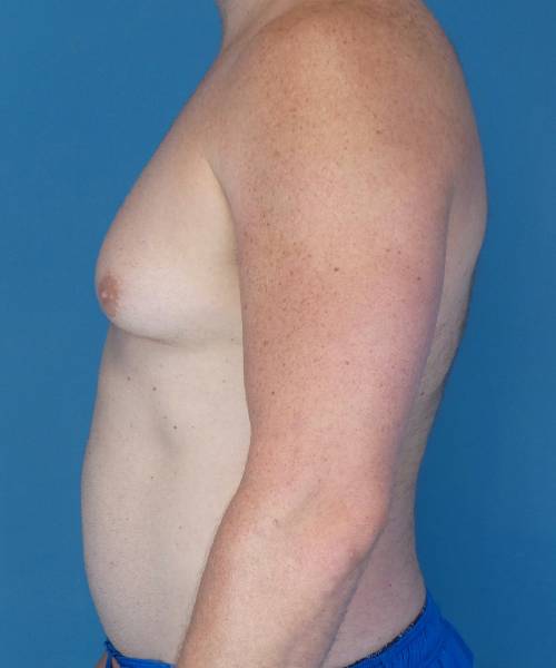 before gynecomastia left side view male patient case 1446