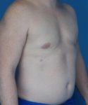 after gynecomastia right angle view male patient case 1446