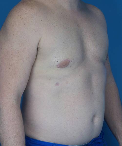 after gynecomastia right angle view male patient case 1446