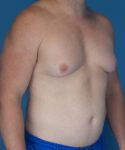 before gynecomastia right angle view male patient case 1446