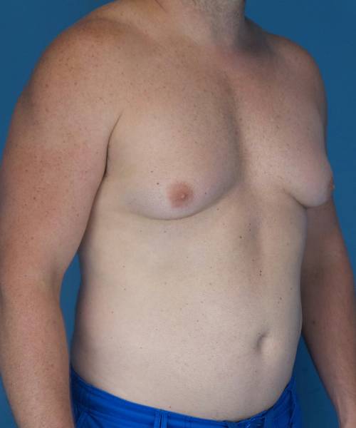 before gynecomastia right angle view male patient case 1446