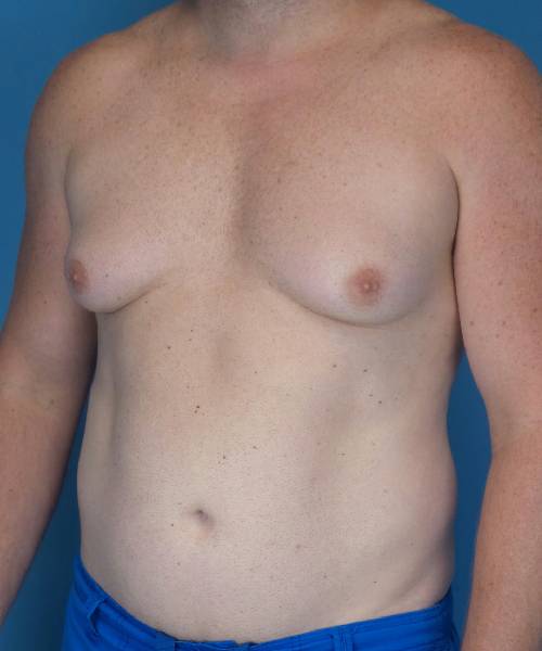 before gynecomastia left angle view male patient case 1446
