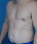 before gynecomastia left angle view male patient case 1446