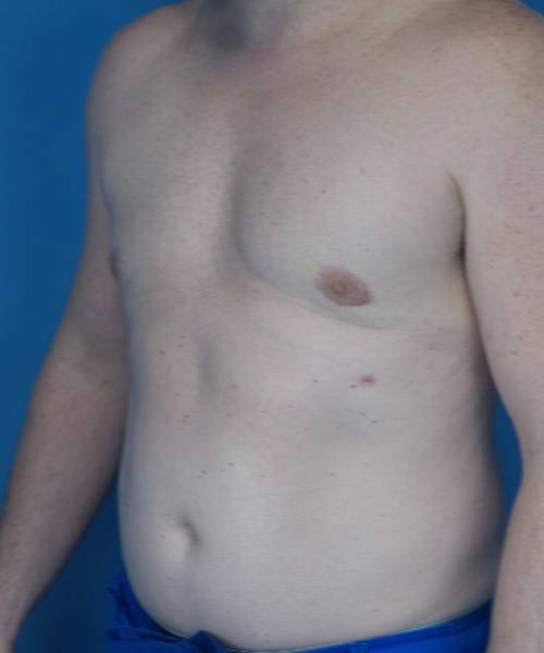 before gynecomastia left angle view male patient case 1446