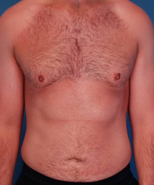 after gynecomastia front view male patient case 1439
