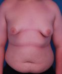 before gynecomastia front view male patient case 1439