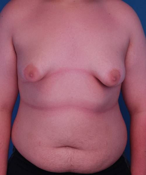 before gynecomastia front view male patient case 1439