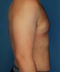 after gynecomastia right side view male patient case 1439