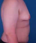 before gynecomastia right side view male patient case 1439