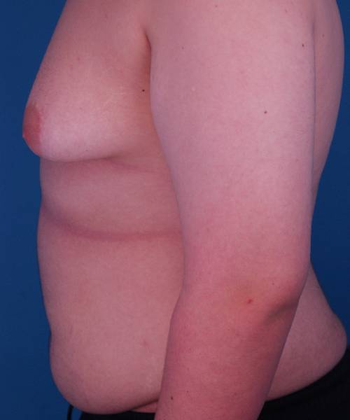 before gynecomastia left side view male patient case 1439
