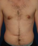 after gynecomastia front view case 1430 | Crispin Plastic Surgery