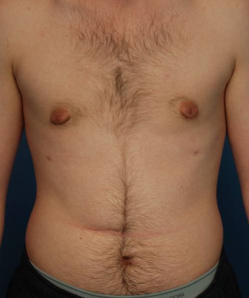 after gynecomastia front view case 1430 | Crispin Plastic Surgery