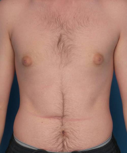 before gynecomastia front view case 1430 | Crispin Plastic Surgery