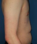 after gynecomastia right side view case 1430 | Crispin Plastic Surgery