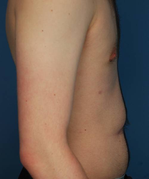 after gynecomastia right side view case 1430 | Crispin Plastic Surgery