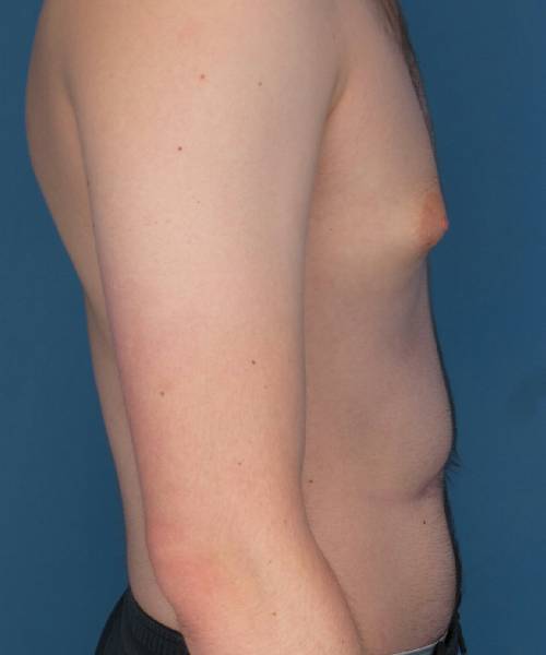 before gynecomastia right side view case 1430 | Crispin Plastic Surgery