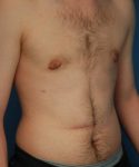 after gynecomastia right angle view case 1430 | Crispin Plastic Surgery