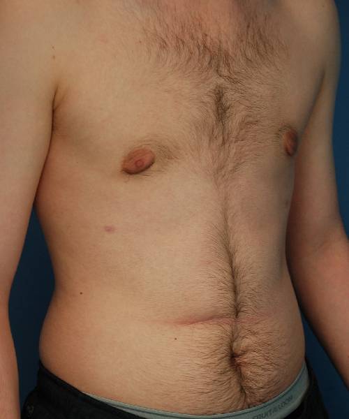 after gynecomastia right angle view case 1430 | Crispin Plastic Surgery