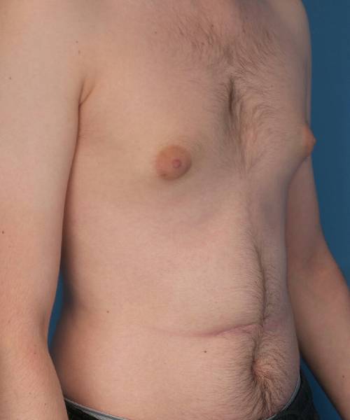 before gynecomastia right angle view case 1430 | Crispin Plastic Surgery