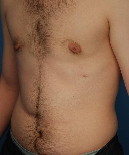 after gynecomastia left angle view case 1430 | Crispin Plastic Surgery