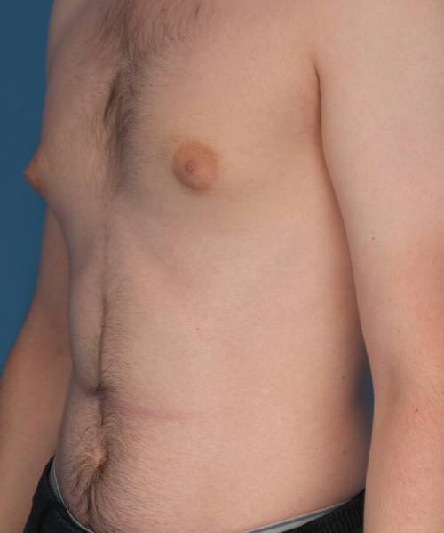 before gynecomastia left angle view case 1430 | Crispin Plastic Surgery