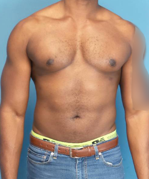 after gynecomastia male patient front view case 1410