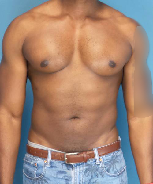 before gynecomastia front view case 1410