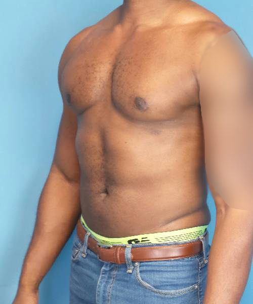 after gynecomastia male patient left angled view case 1410