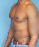 before gynecomastia male patient left angled view case 1410