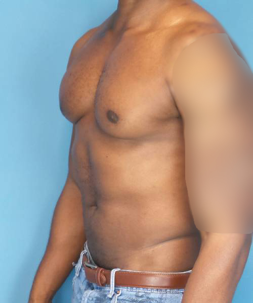 before gynecomastia male patient left angled view case 1410