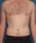 after gynecomastia front view male patient case 2797