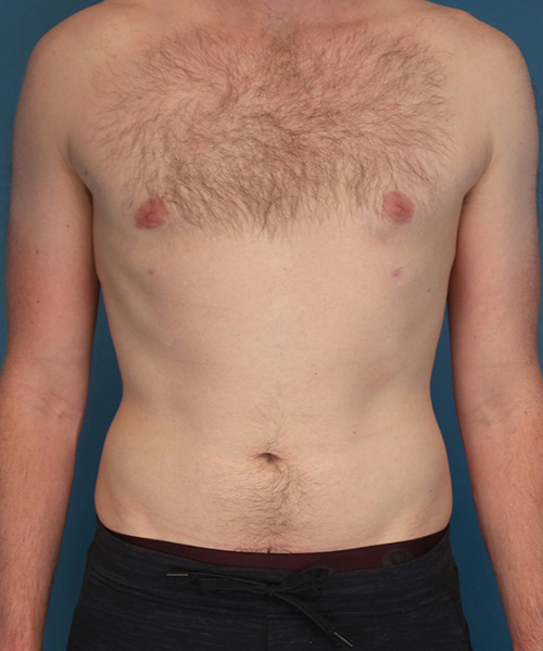 after gynecomastia front view male patient case 2797