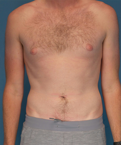 before gynecomastia front view male patient case 2797