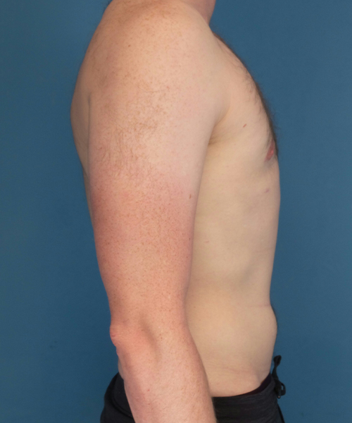 after gynecomastia right side view male patient case 2797