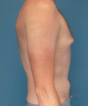 before gynecomastia right side view male patient case 2797
