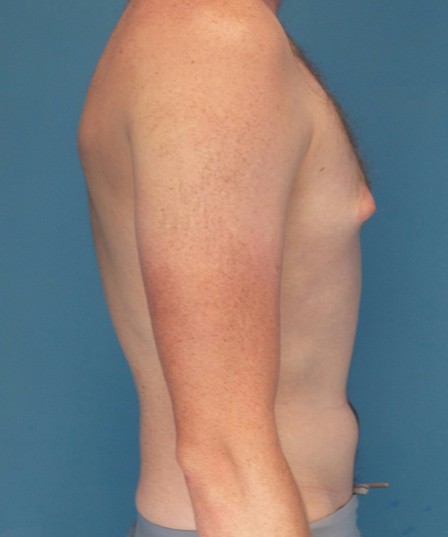 before gynecomastia right side view male patient case 2797