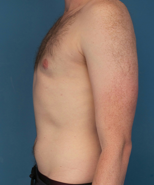 after gynecomastia left side view male patient case 2797
