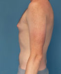 before gynecomastia left side view male patient case 2797