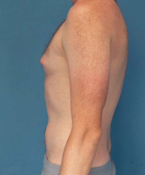 before gynecomastia left side view male patient case 2797