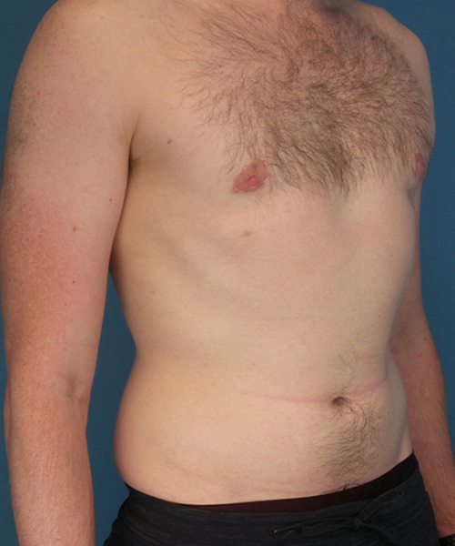 after gynecomastia right angle view male patient case 2797